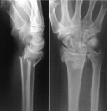 Gambar .Gambaran radiologi fraktur dan abnormalitas distal lengan bawah  