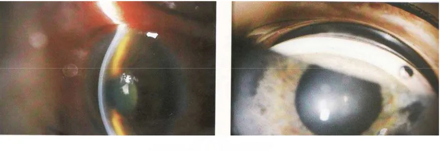 Gambar 6 : Pupil dilatasi dan oval pada glaukoma akut.2 