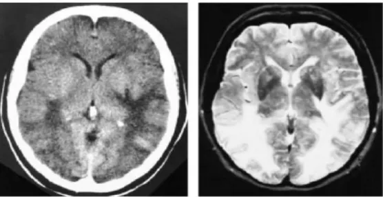 Gambar 1 Gambaran  CT Scan (kanan) dan MRI (kiri) kepala pada wanita 55  tahun  dengan  Ensefalopati  Hipertensi  dan  kejang  menunjukkan  adanya  lesi  white matter yang terkonsentrasi pada bagian posterior otak 