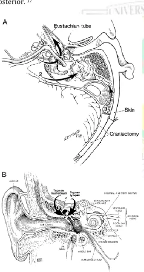 Gambar  4.  A.  Rute  kebocoran  CSS  yang  melibatkan tulang temporal, Kanalis akustikus  internus  (1),  sel  udara  retrolabirin  (2),  sel  udara  mastoid  lateral