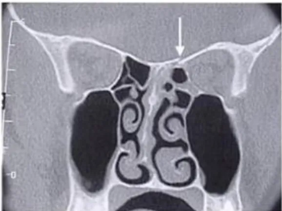 Gambar 6. CT Scan potongan koronal pada  pasien pasca trauma dengan fraktur di fovea 