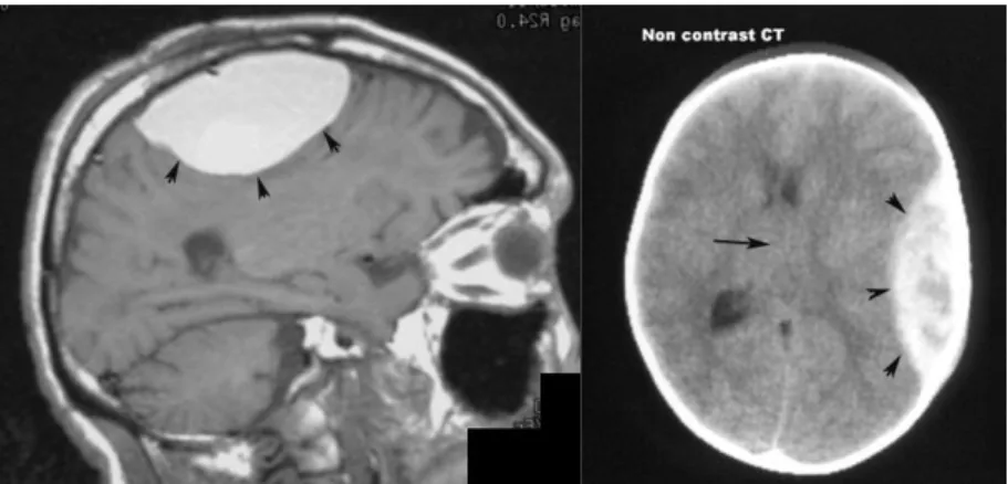 Gambar 3. Epidural Hematoma 5
