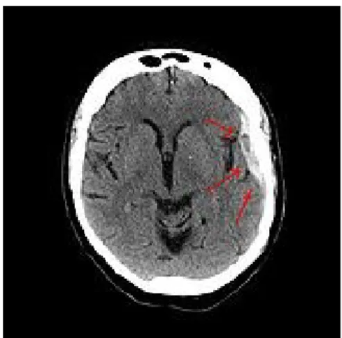 Gambar 6. Subdural hematoma 2. Hematoma Subarachnoid
