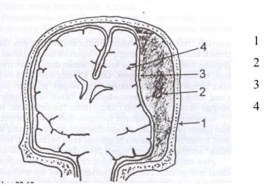Gambar 2. Hematom Epidural