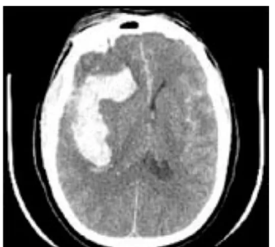 Gambar 8. CT-Scan pada Intracerebral Hematoma Dikutip dari kepustakaan