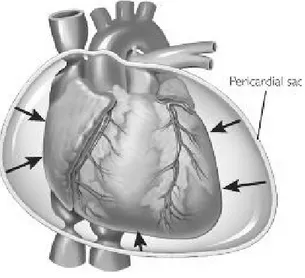 Gambar 2.5 Tamponade Jantung
