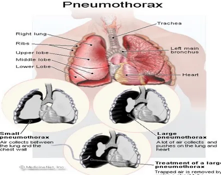 Gambar 2.4 Pneumothorax