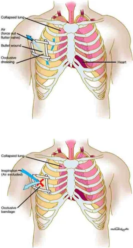 Gambar 2.3 Pneumothorax Terbuka