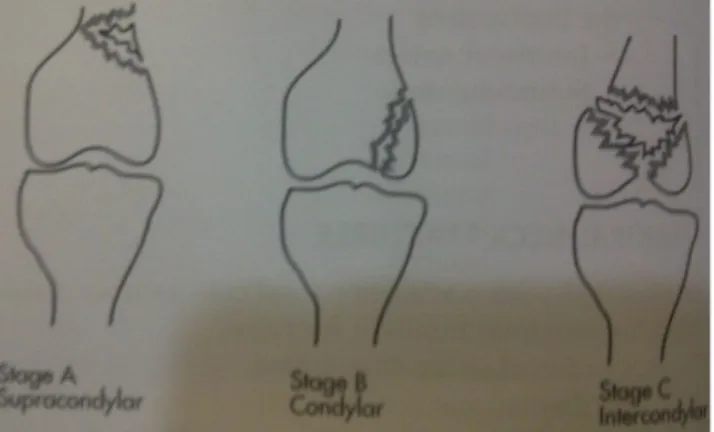 Gambar 5. Fraktur femur distal Fraktur suprakondiler femur
