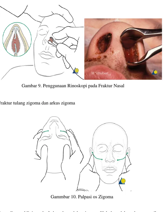 Gambar 9. Penggunaan Rinoskopi pada Fraktur Nasal 
