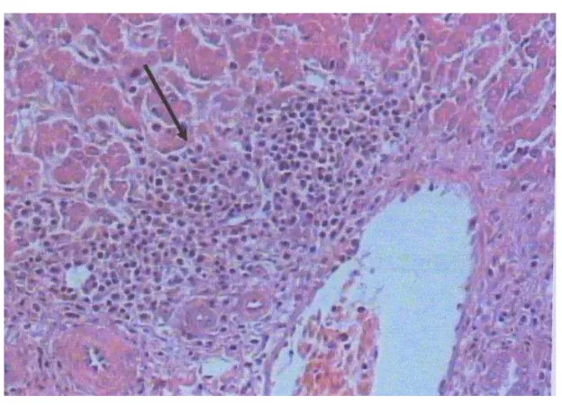 Gambar 7 Fotomikrograf hati ayam yang diinfeksi virus Marek (MDV)                      dosis 0.125 x 103 EID50 pewarnaan Hematoksilin-Eosin (HE)