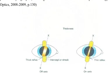Gambar 3 : Patahan. Refleks retina terputus dengan patahan bila lintasan tidak tepat 