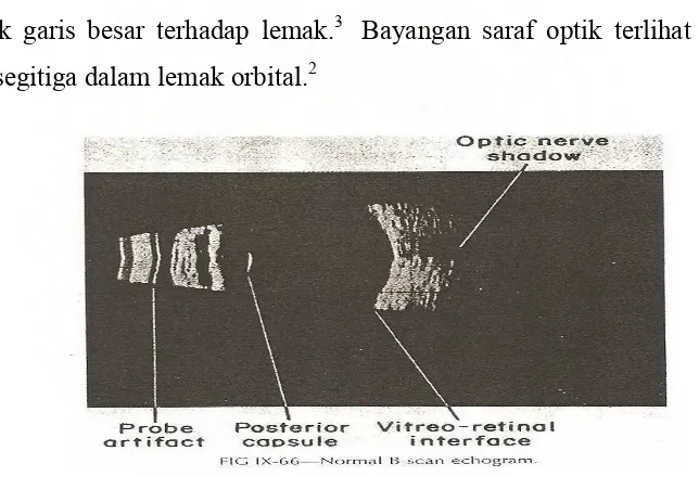 Gambar 8: Tampilan normal dari B scan ( From  fig 9.66 American Academy of   