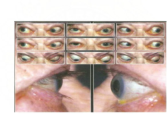 Gambar 2 : Myopati tyroid restriktif( dikutip dari fig 6.10 Kanski JJ, Thyroid Eye Disease, Clinical Ophtalmology A Systematic Approach, sixth edition, Butterworth Hanemann, China, 2007, p 174)  