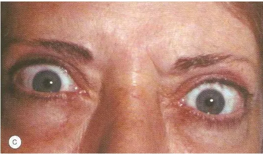 Gambar 3 : Retraksi kelopak mata (dikutip dari : Kanski JJ, Thyroid Eye Disease, Clinical Ophtalmology A Systematic Approach, sixth edition, Butterworth Hanemann, China, 2007, p 172)