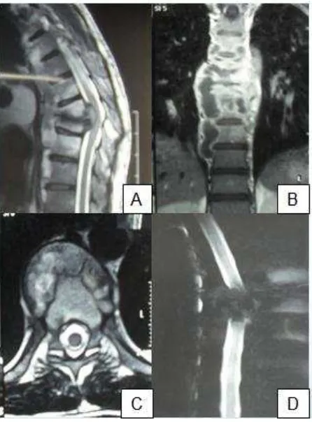 Figure 2. A) On T2WI MRI reveal hipointens on extradura which compress the spinal cord and bone destruction > 50%