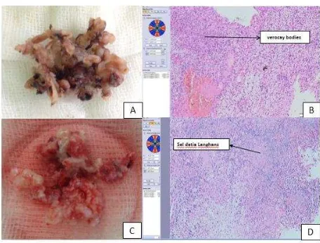 Figure 4. A). Picture of the tumor after removal B). Histopathology result show schwannoma antoni 