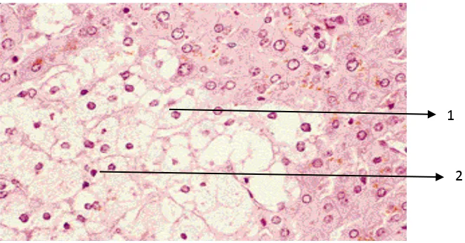 Gambar 6. Pembengkakan sel disertai vakuolisasi; Ket.: 1. Sel yang MengalamiVakuolisasi;  2