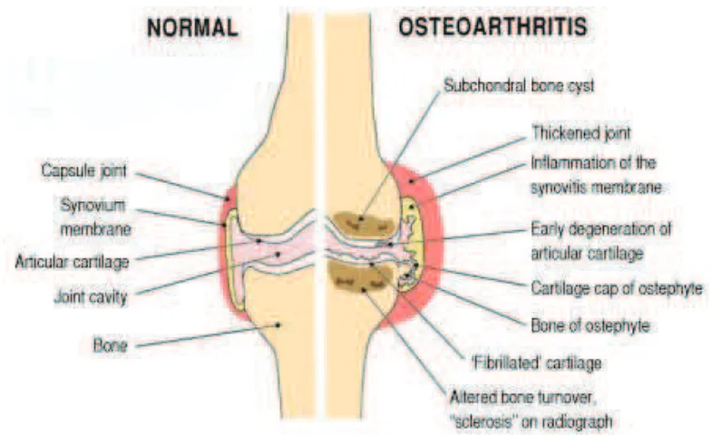 Figure 2.1Comparison of Normal Joint and Joint which have Osteoarthritis