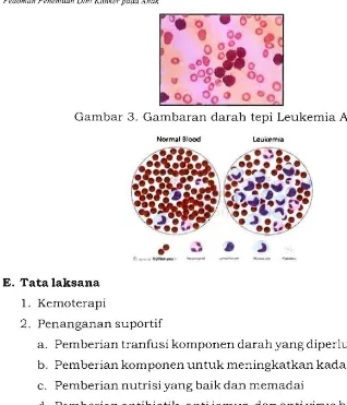 Gambar 3. Gambaran darah tepi Leukemia Akut 