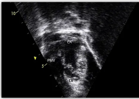Figure 4. Transthoracal Echocardiography (TTE), parasternal long axis view showed small VSD, fromapical view, systolic frame showed MR-MS.(VSD: Ventricular Septal Defect, MR: Mitral regurgitation, MS: Mitral Stenosis)