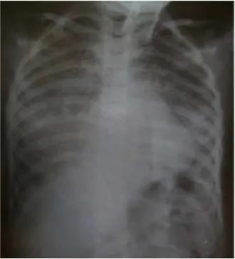 Figure 4. Chest X ray, child with Shone’s anomaly showed cardiomegaly (CTR 58 %) and confluentalveolar opacities.