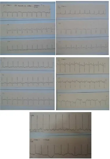 Figure 5. Electrocardiography indicated sinus tachycardi, RAD, RAH, RVH