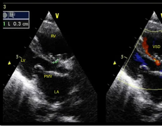 Figure 6. Transthoracic echocardiography, parasternal long axis view, showing hipoplastic LV, PMV and VSD3 mm