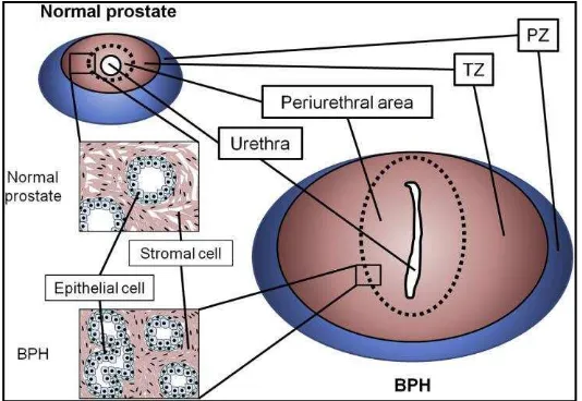 Gambar 4. Prostat normal dan BPH. TZ (Transitional Zone) dan PZ (Peripheral Zone) (Sumber: Izumi dkk., 2013)
