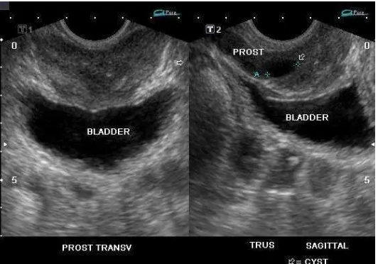 Gambar 9. Transrectal Ultrasonography  (TRUS) (Sumber: Singh dkk., 2006). 