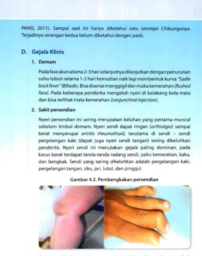 Gambar 4.2. Pembengkakan persendian 