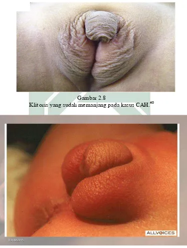  Gambar 2.8 Klitoris yang sudah memanjang pada kasus CAH.