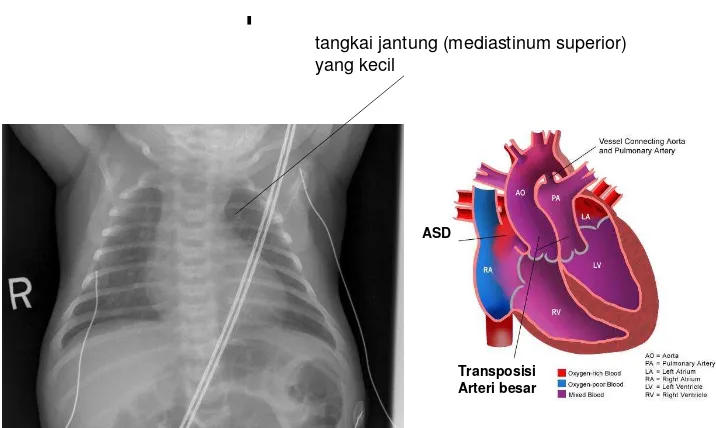 Gambar 10.  Foto dada Transposisi arteri besar  