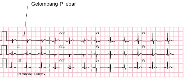 Gambar 19.  EKG Pembesaran atrium kanan 
