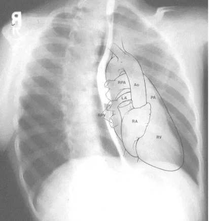 Gambar 1.  Ruang ruang jantung pada foto PA  