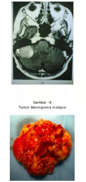 Tumor Gambar -6 Meningioma maligna 