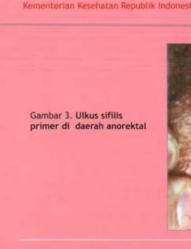 Gambar 3.  Ulkus sifllis 