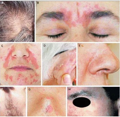 Gambar 2.1.Manifestasi klinis dermatitis seboroik (Naldi, 2009). 