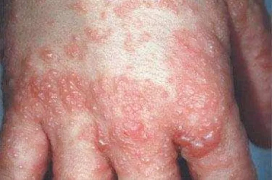 Gambar 1. Dermatitis Atopik (Williams, 2005) 