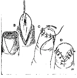 Gambar 4,1 V-Y advancement flap