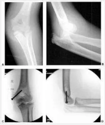 Gambar 6. A,B : medial epikondikondiler fraktur dan elbow dislokasi. C,D : postopepostoperative dengan