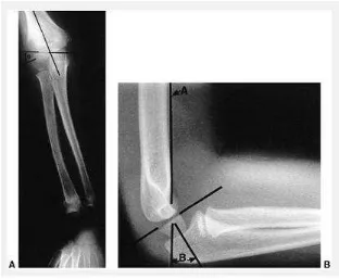 Gambar 1. Garis radiologic dan an sudut pemeriksaan pada sendi bahu, A. Baumaumann's. B