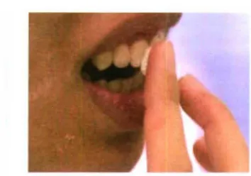 Gambar II. Aplikasi sediaan calcium-phosphate pada permukaan gigi 
