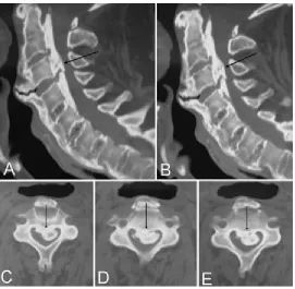 Figure 2. Computed tomography scans showing OPLL in different locations.  