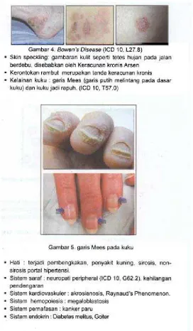 Gambar 4 . Bowen's Disease (ICD 10, L27.8)