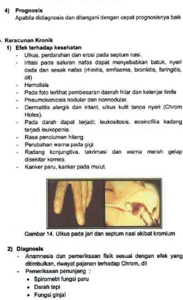 Gambar 14. Ulkus pada jari dan septum nasi akibat kromium
