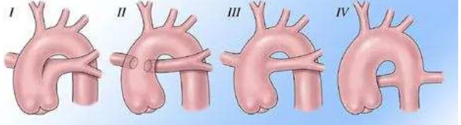 Gambar 6 Tipe Trunkus Arteriosus Berdasarkan Tempat Keluarnya Arteri Pulmonalis 