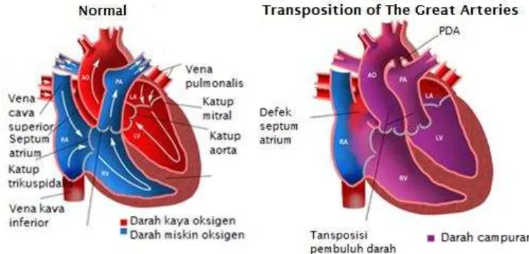 Gambar 4 Anantomi dan Patofisiologi Transposisi Arteri Besar          