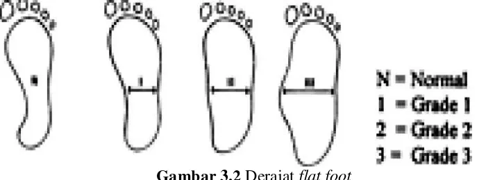 Gambar 3.2 Derajat flat foot 