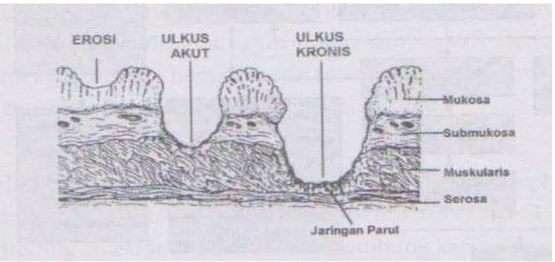 Gambar 2.5 Ilustrasi ulkus peptikum.  Keterangan:  Ilustrasi  ulkus peptikum meliputi gambaran erosi, ulkus akut dan ulkus kronis pada dinding lambung (Lewis, 2000)